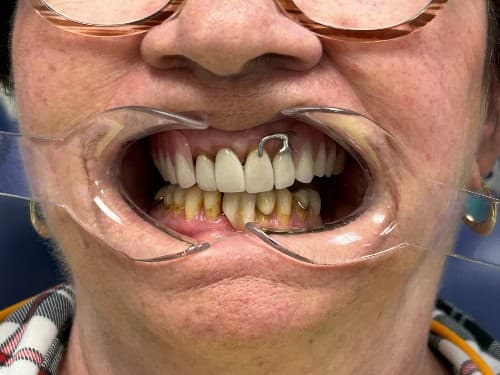 After: a new denture re-establishing the bite