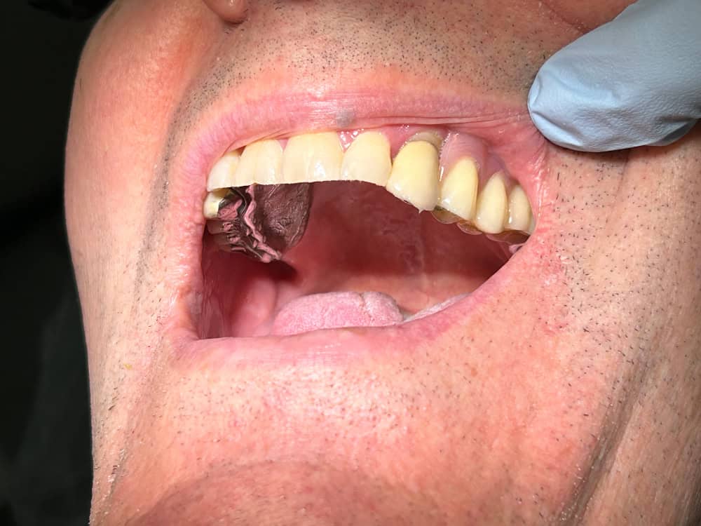 After: the finished partial denture in place