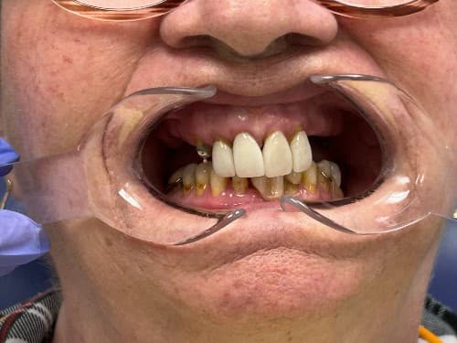 Before: a collapsed bite with missing teeth