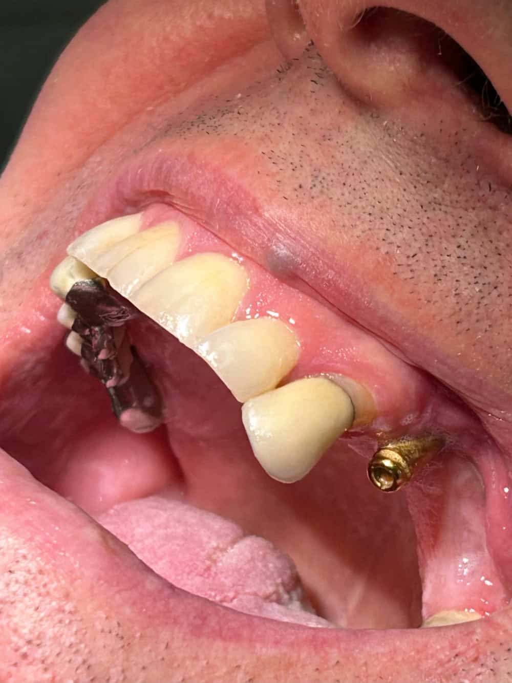 Before: a failed implant-supported bridge