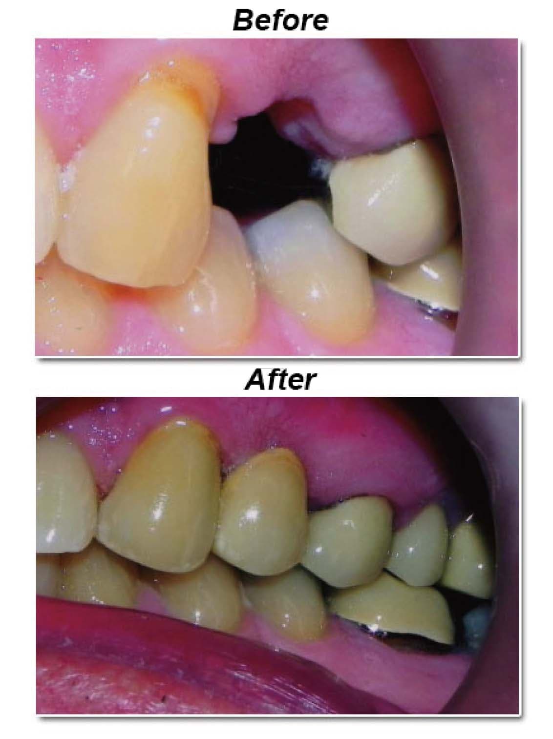 Cantilever bridge, before and after