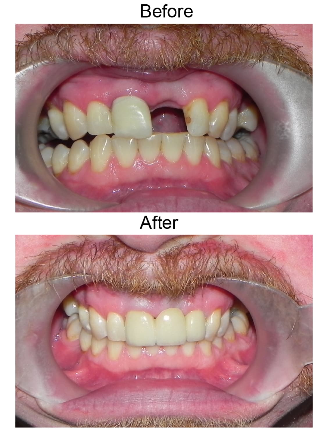Three unit bridge in the front, before and after