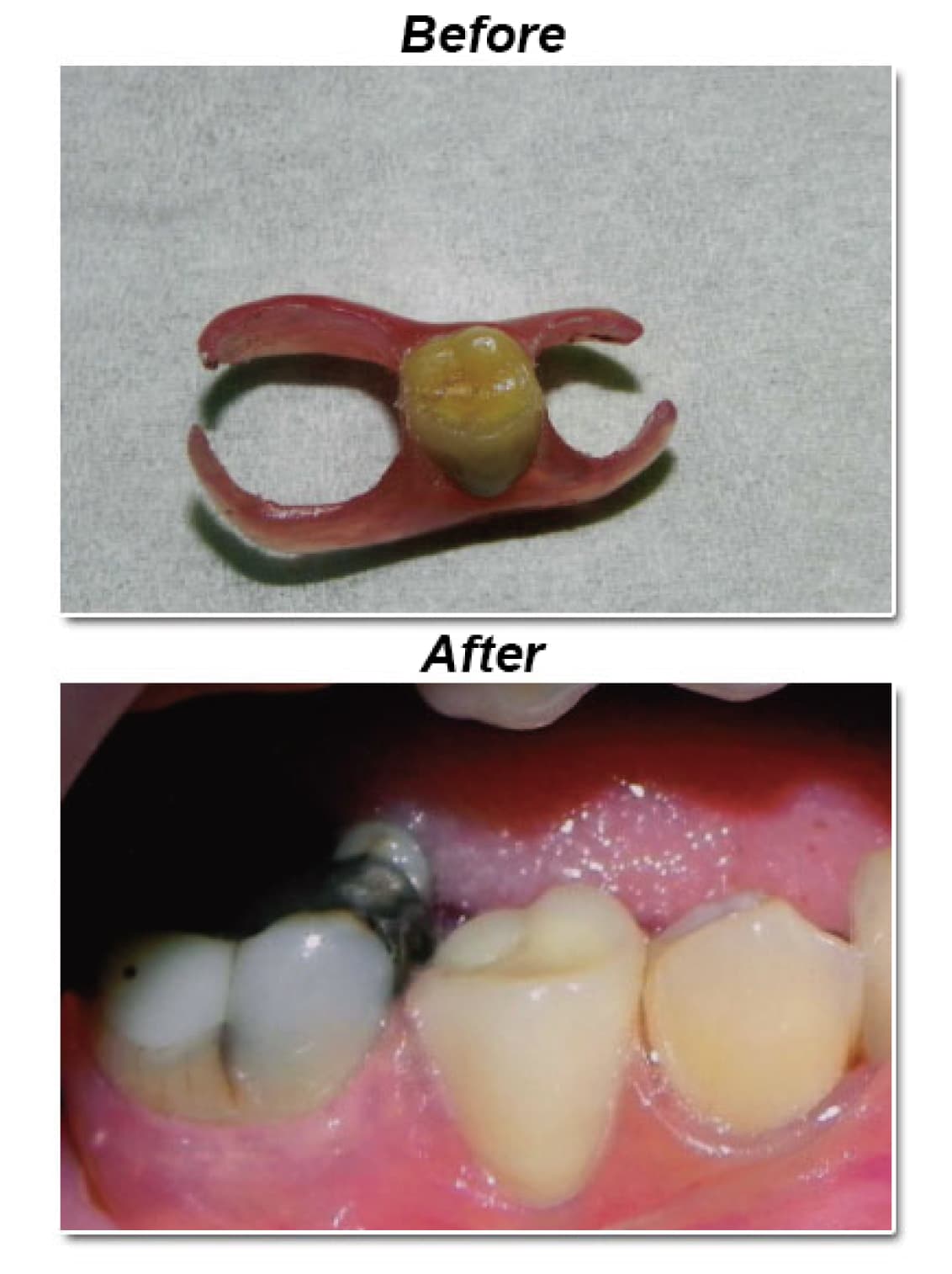 Flexible denture, before and after