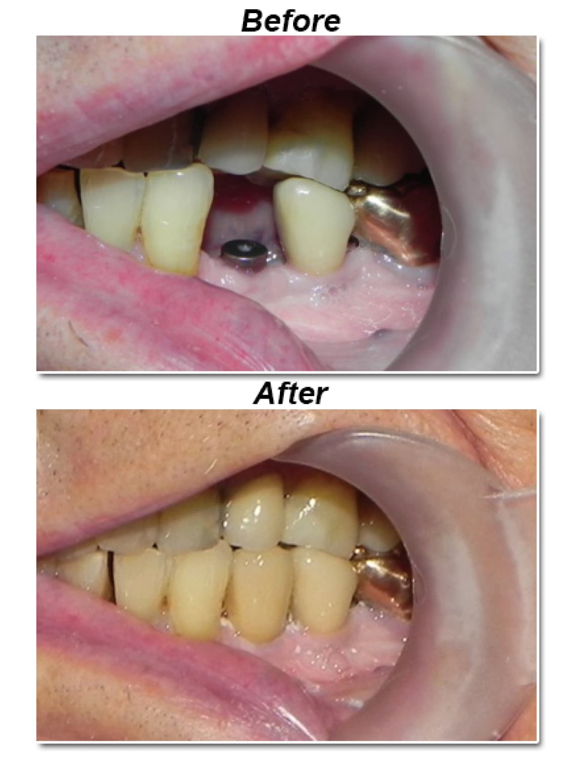 Implant-supported crown, before and after