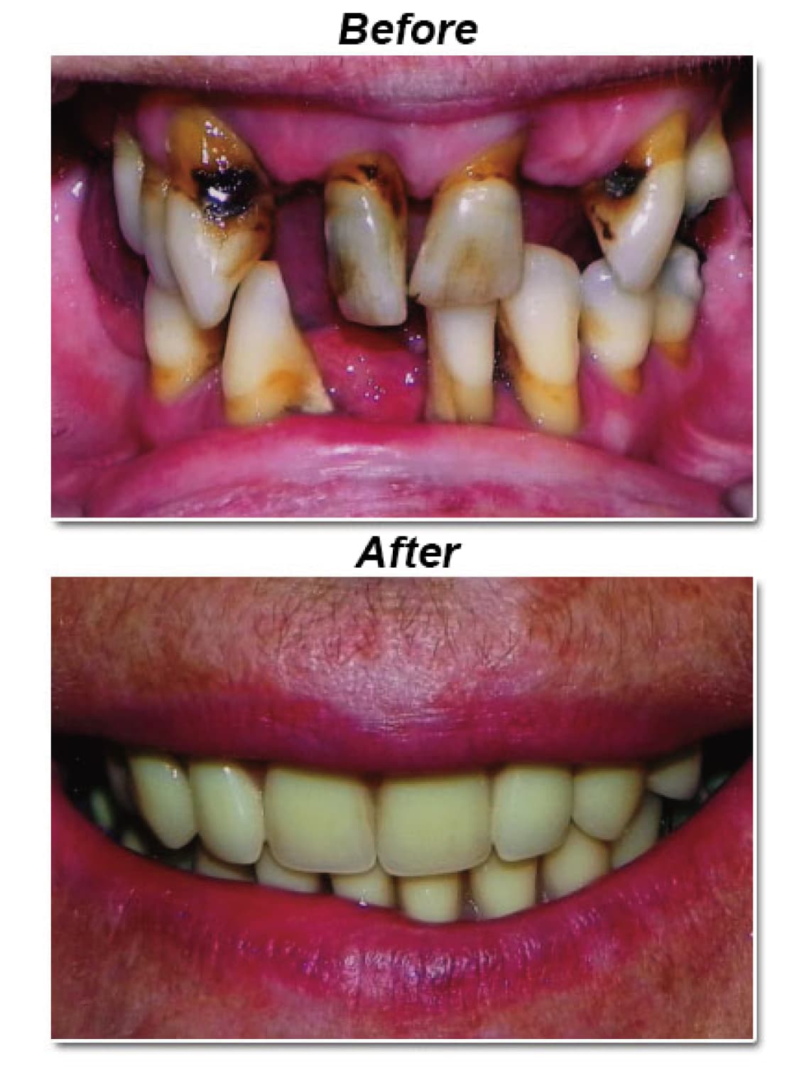 Complete denture, before and after